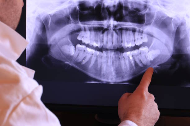 Best Emergency Wisdom Tooth Extraction in Bountiful, UT
